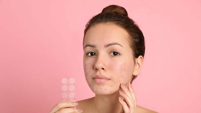 Lo que_necesita saber sobre el acné